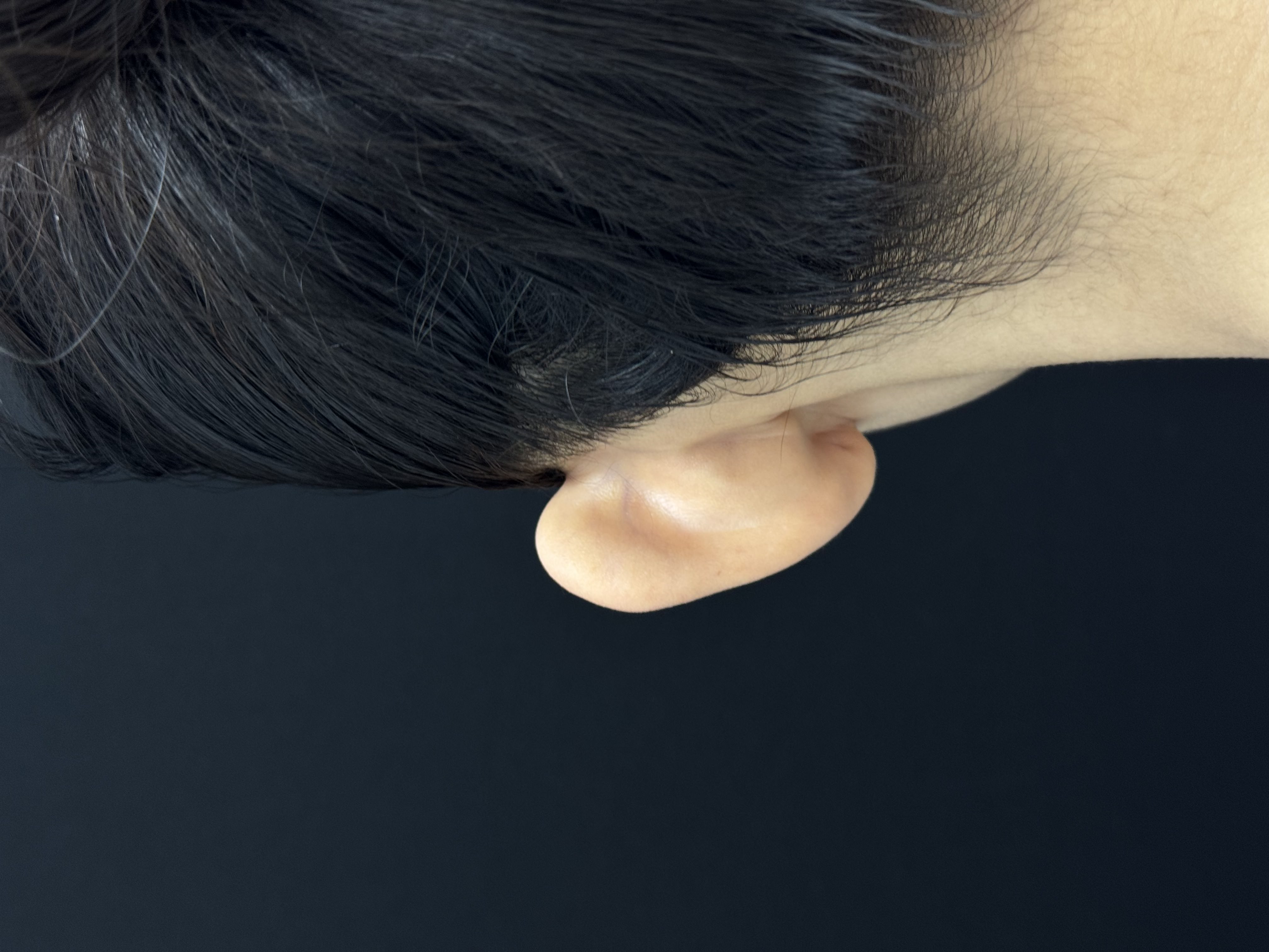 Отопластика